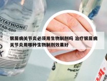 银屑病关节炎必须用生物制剂吗 治疗银屑病关节炎用哪种生物制剂效果好