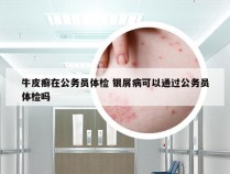 牛皮癣在公务员体检 银屑病可以通过公务员体检吗