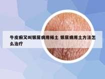 牛皮癣又叫银屑病用稀土 银屑病用土方法怎么治疗