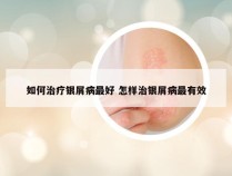 如何治疗银屑病最好 怎样治银屑病最有效