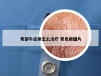 背部牛皮癣怎么治疗 背皮癣图片