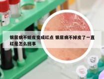 银屑病不蜕皮变成红点 银屑病不掉皮了一直红是怎么回事