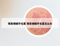 银屑病破坏毛囊 银屑病破坏毛囊怎么办