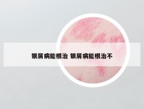 银屑病能根治 银屑病能根治不