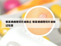 银屑病病理切片谁做过 银屑病病理切片谁做过检查