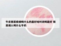 牛皮银屑癣病喝什么奶最好啥时间喝最好 银屑病人喝什么牛奶