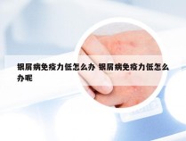 银屑病免疫力低怎么办 银屑病免疫力低怎么办呢