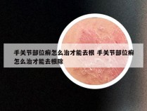 手关节部位癣怎么治才能去根 手关节部位癣怎么治才能去根除