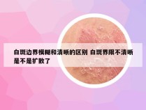 白斑边界模糊和清晰的区别 白斑界限不清晰是不是扩散了