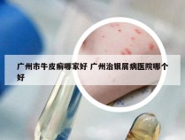 广州市牛皮癣哪家好 广州治银屑病医院哪个好