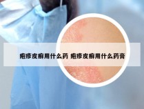 疱疹皮癣用什么药 疱疹皮癣用什么药膏