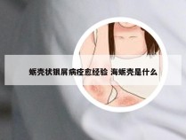 蛎壳状银屑病痊愈经验 海蛎壳是什么