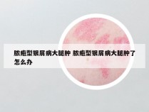 脓疱型银屑病大腿肿 脓疱型银屑病大腿肿了怎么办