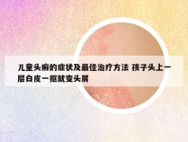 儿童头癣的症状及最佳治疗方法 孩子头上一层白皮一抠就变头屑