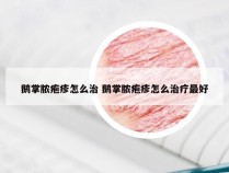 鹅掌脓疱疹怎么治 鹅掌脓疱疹怎么治疗最好