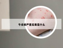 牛皮癣严重后果是什么