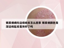 银屑病病灶边缘蜕皮怎么回事 银屑病颜色变深边缘起皮是快好了吗