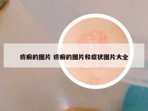 疥癣的图片 疥癣的图片和症状图片大全