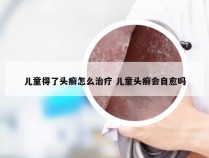 儿童得了头癣怎么治疗 儿童头癣会自愈吗