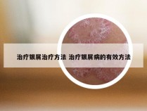 治疗银屑治疗方法 治疗银屑病的有效方法