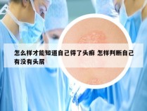 怎么样才能知道自己得了头癣 怎样判断自己有没有头屑