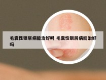 毛囊性银屑病能治好吗 毛囊性银屑病能治好吗