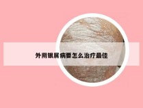 外阴银屑病要怎么治疗最佳