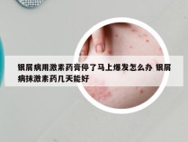 银屑病用激素药膏停了马上爆发怎么办 银屑病抹激素药几天能好