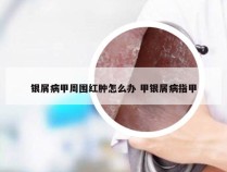 银屑病甲周围红肿怎么办 甲银屑病指甲