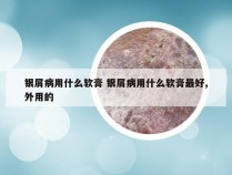 银屑病用什么软膏 银屑病用什么软膏最好,外用的