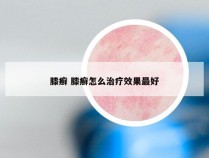 膝癣 膝癣怎么治疗效果最好