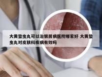 大黄蛰虫丸可以治银屑病医院哪家好 大黄蛰虫丸对皮肤科疾病有效吗