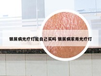 银屑病光疗灯能自己买吗 银屑病家用光疗灯