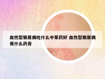 血热型银屑病吃什么中草药好 血热型银屑病用什么药膏