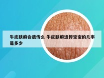 牛皮肤癣会遗传么 牛皮肤癣遗传宝宝的几率是多少