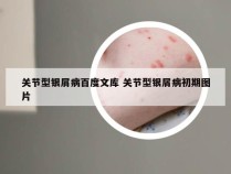 关节型银屑病百度文库 关节型银屑病初期图片