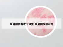 银屑病哪有皮下埋置 银屑病皮损可见