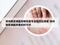 郑州银屑病医院哪家最专业医院在哪里 郑州银屑病医院看的好不好