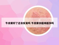 牛皮廨好了还会反复吗 牛皮廨会越来越多吗