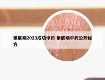 银屑病2023成功中药 银屑病中药公开秘方