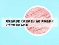 男生隐私部位长皮肤癣怎么治疗 男生隐私长了个疙瘩是怎么回事