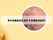 有牛皮廨能性生活吗 牛皮廨能传染吗?