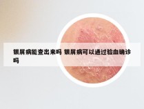 银屑病能查出来吗 银屑病可以通过验血确诊吗