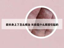 藓长身上了怎么根治 长藓是什么原因引起的