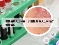 银屑病用凡士林有什么副作用 白凡士林治疗银屑病吗