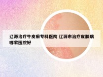 辽源治疗牛皮癣专科医院 辽源市治疗皮肤病哪家医院好