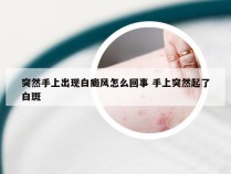 突然手上出现白癜风怎么回事 手上突然起了白斑