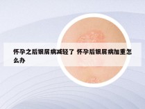 怀孕之后银屑病减轻了 怀孕后银屑病加重怎么办