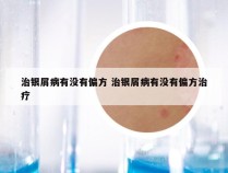 治银屑病有没有偏方 治银屑病有没有偏方治疗