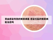 常由感染导致的银屑病是 感染引起的银屑病能治愈吗